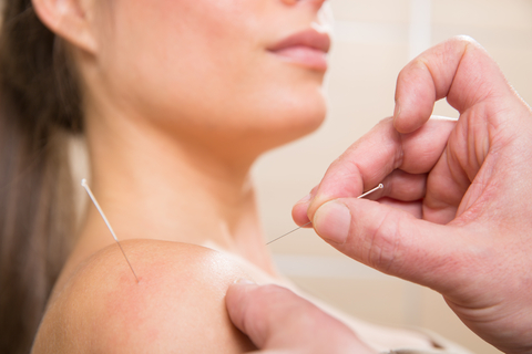 Dry Needling